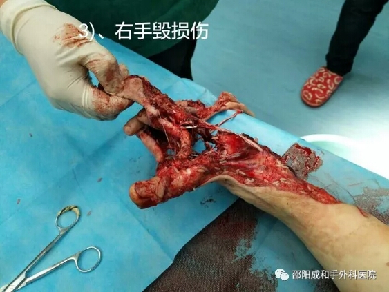 邵陽創傷骨科,邵陽風濕病區,邵陽骨質增生,邵陽關節病區,邵陽頸椎病區