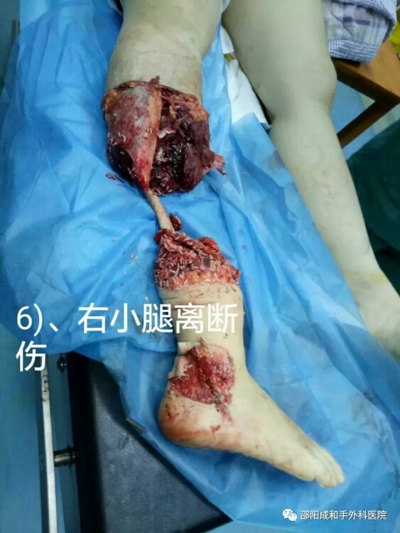 邵陽創傷骨科,邵陽風濕病區,邵陽骨質增生,邵陽關節病區,邵陽頸椎病區 邵陽創傷骨科,邵陽風濕病區,邵陽骨質增生,邵陽關節病區,邵陽頸椎病區