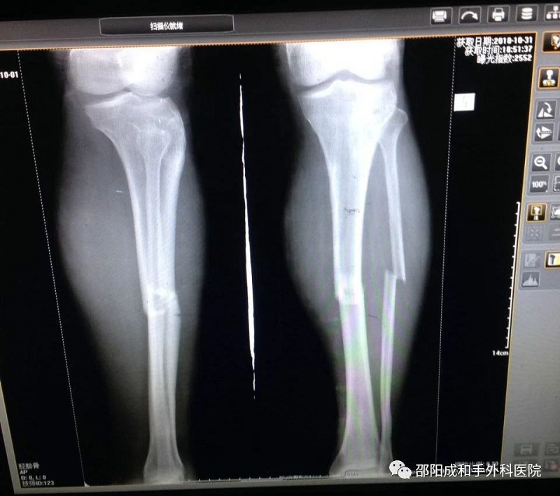 邵陽創傷骨科,邵陽風濕病區,邵陽骨質增生,邵陽關節病區,邵陽頸椎病區
