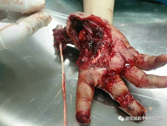 邵陽創傷骨科,邵陽風濕病區,邵陽骨質增生,邵陽關節病區,邵陽頸椎病區
