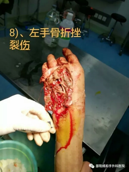 邵陽創傷骨科,邵陽風濕病區,邵陽骨質增生,邵陽關節病區,邵陽頸椎病區