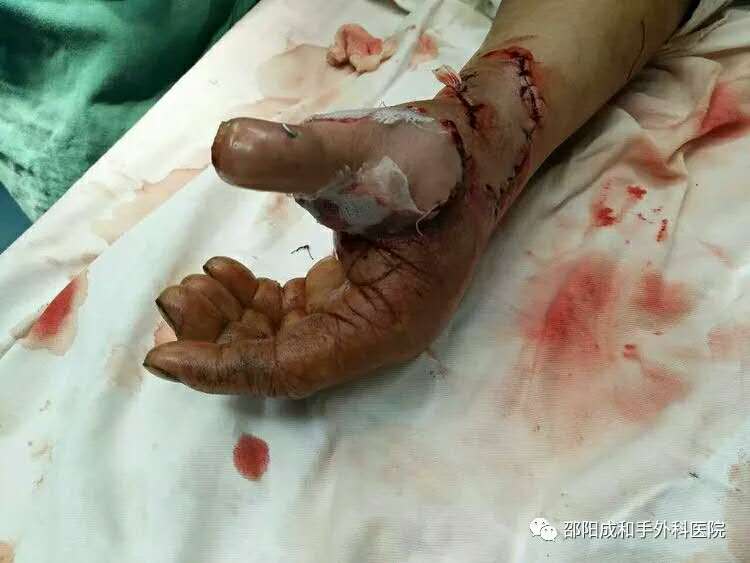 邵陽創傷骨科,邵陽風濕病區,邵陽骨質增生,邵陽關節病區,邵陽頸椎病區