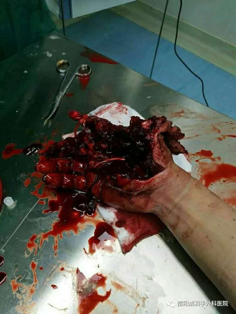 邵陽創傷骨科,邵陽風濕病區,邵陽骨質增生,邵陽關節病區,邵陽頸椎病區