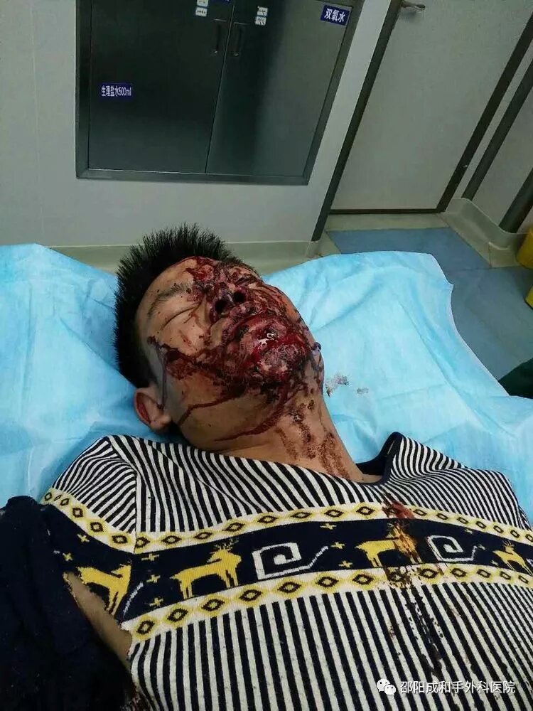 邵陽創傷骨科,邵陽風濕病區,邵陽骨質增生,邵陽關節病區,邵陽頸椎病區
