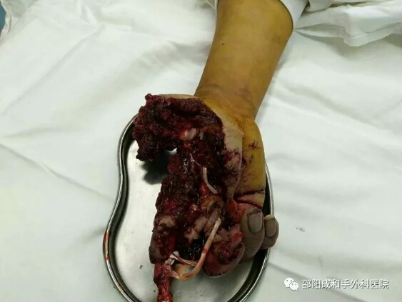 邵陽創傷骨科,邵陽風濕病區,邵陽骨質增生,邵陽關節病區,邵陽頸椎病區