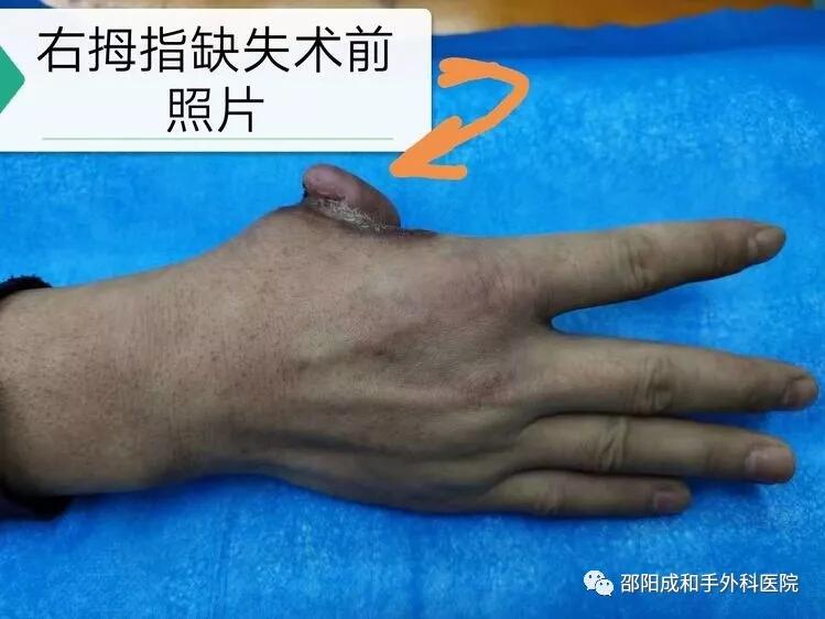 邵陽創傷骨科,邵陽風濕病區,邵陽骨質增生,邵陽關節病區,邵陽頸椎病區