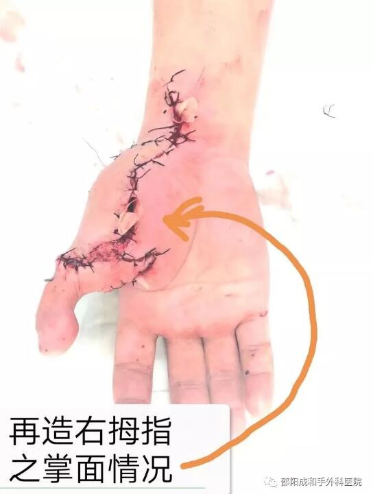 邵陽創傷骨科,邵陽風濕病區,邵陽骨質增生,邵陽關節病區,邵陽頸椎病區