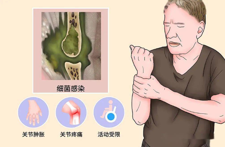 邵陽創傷骨科,邵陽風濕病區,邵陽骨質增生,邵陽關節病區,邵陽頸椎病區
