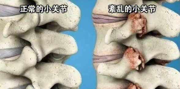 邵陽創傷骨科,邵陽風濕病區,邵陽骨質增生,邵陽關節病區,邵陽頸椎病區