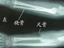 邵陽創傷骨科,邵陽風濕病區,邵陽骨質增生,邵陽關節病區,邵陽頸椎病區