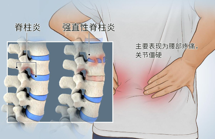 邵陽創傷骨科,邵陽風濕病區,邵陽骨質增生,邵陽關節病區,邵陽頸椎病區