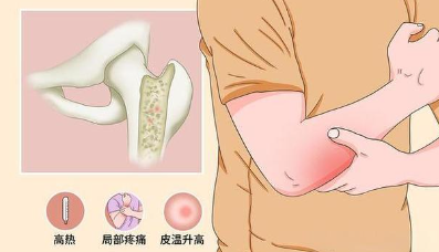 邵陽創傷骨科,邵陽風濕病區,邵陽骨質增生,邵陽關節病區,邵陽頸椎病區