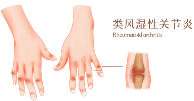 邵陽創傷骨科,邵陽風濕病區,邵陽骨質增生,邵陽關節病區,邵陽頸椎病區