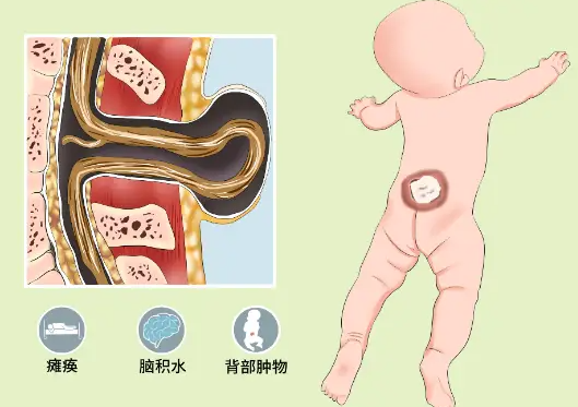 邵陽創傷骨科,邵陽風濕病區,邵陽骨質增生,邵陽關節病區,邵陽頸椎病區